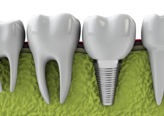 Individaul dental implant