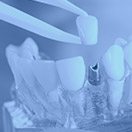 Model implant supported dental crown blue highlight