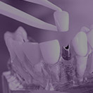 Model implant supported dental crown