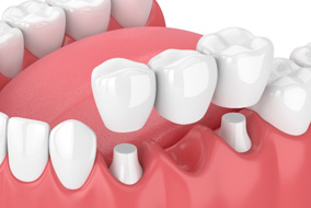 A CGI image of a dental bridge