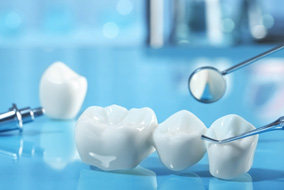 A traditional dental bridge and an implant bridge