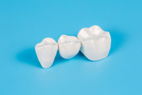 A traditional dental bridge