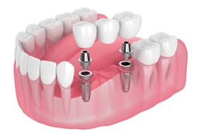 An implant bridge