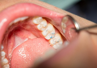 Closeup of teeth during dental restoration