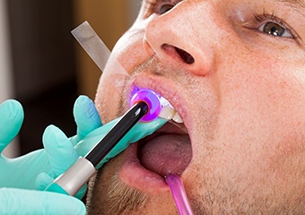 dentist curing composite resin with a light