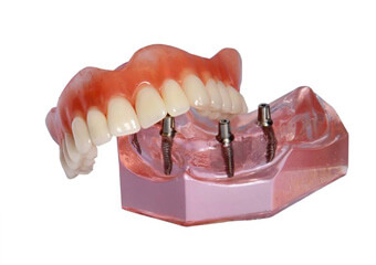 Model of implant denture