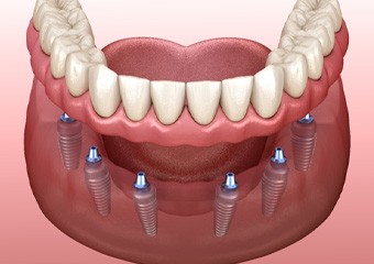 Illustration of implant dentures in Columbia