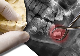 Tooth model and x-rays of teeth to be extracted