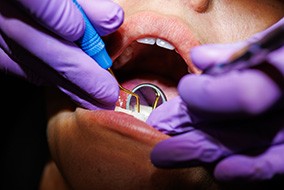 A closeup of a dentist performing scaling and root planing