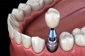 a computer illustration of an implant crown