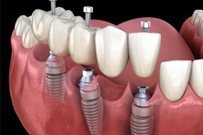 a computer illustration of an implant bridge