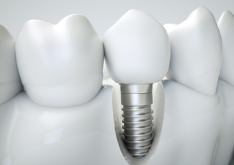 Animation of implant supported dental crown