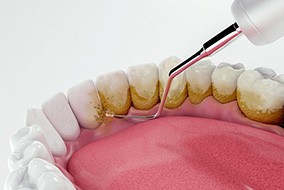 Illustration of dental scaler removing plaque from teeth