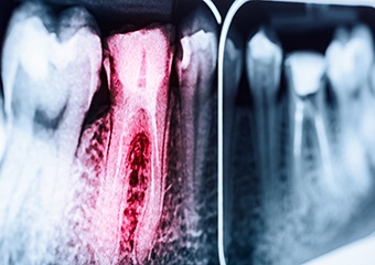 X-rays with root canal treated tooth highlighted red