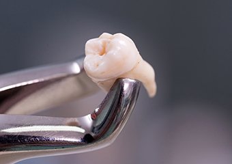 Metal clasp holding extracted tooth