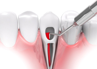 Illustration of root canal therapy in Columbia, TN for single tooth