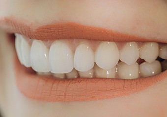 Woman smiling with veneers in Columbia