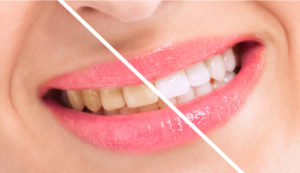 Restore a bright smile with teeth whitening in Columbia.