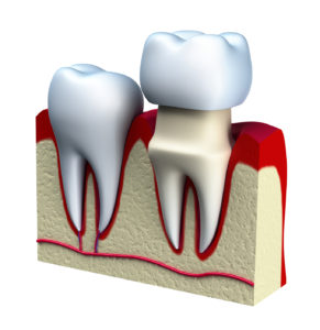 Model of dental crown