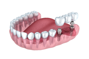 model of implant-supported bridge