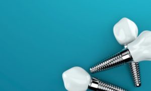 Trio of dental implants 