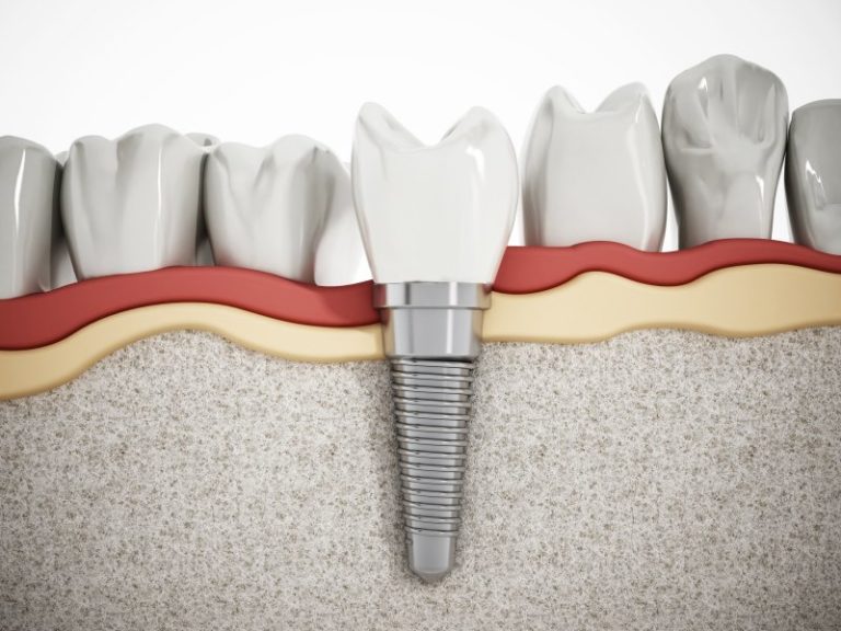 Dental Implants in Columbia Goodman Family Dentistry