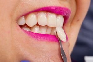 Veneer held in front of woman’s tooth