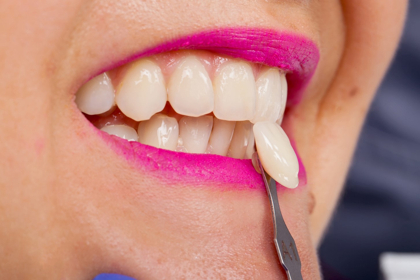 Explore the History of Porcelain Veneers Throughout Time